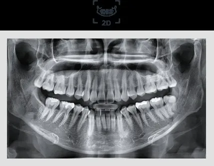 2D dental panoramic X-ray image showing a full set of teeth for Tooth Suite Maine.