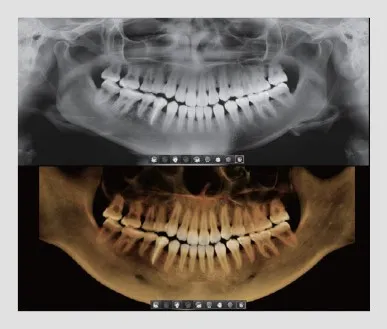 Comparison of a traditional 2D panoramic dental X-ray image and a 3D dental imaging scan for Tooth Suite Maine